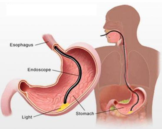 Gastroscopy procedure outline